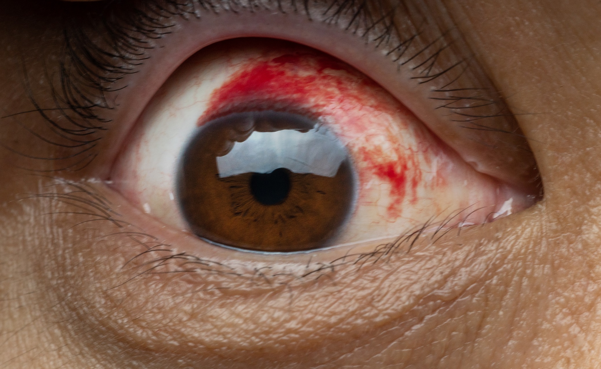 Prevention Of Blood Under Eye Skin