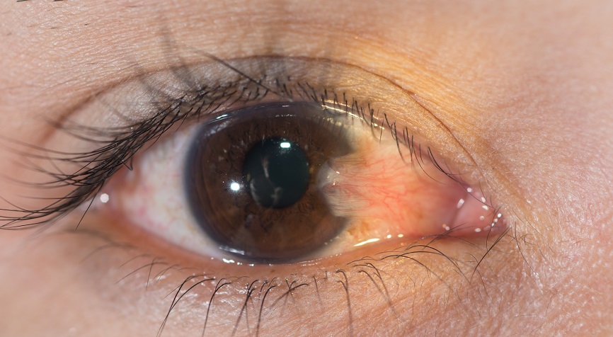 結膜黃斑 Pinguecula 與翼狀胬肉 Pterygium 視力中心 香港 有限公司