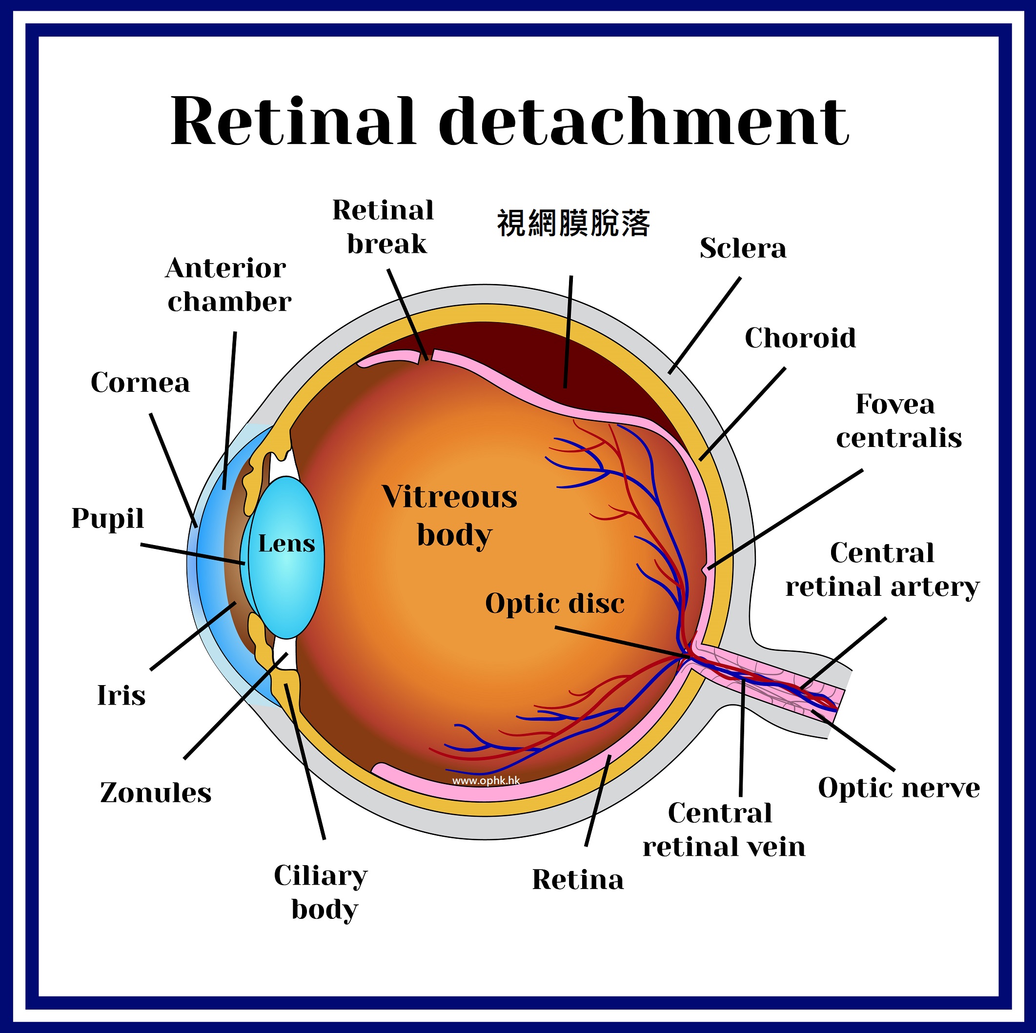retinal-detachment